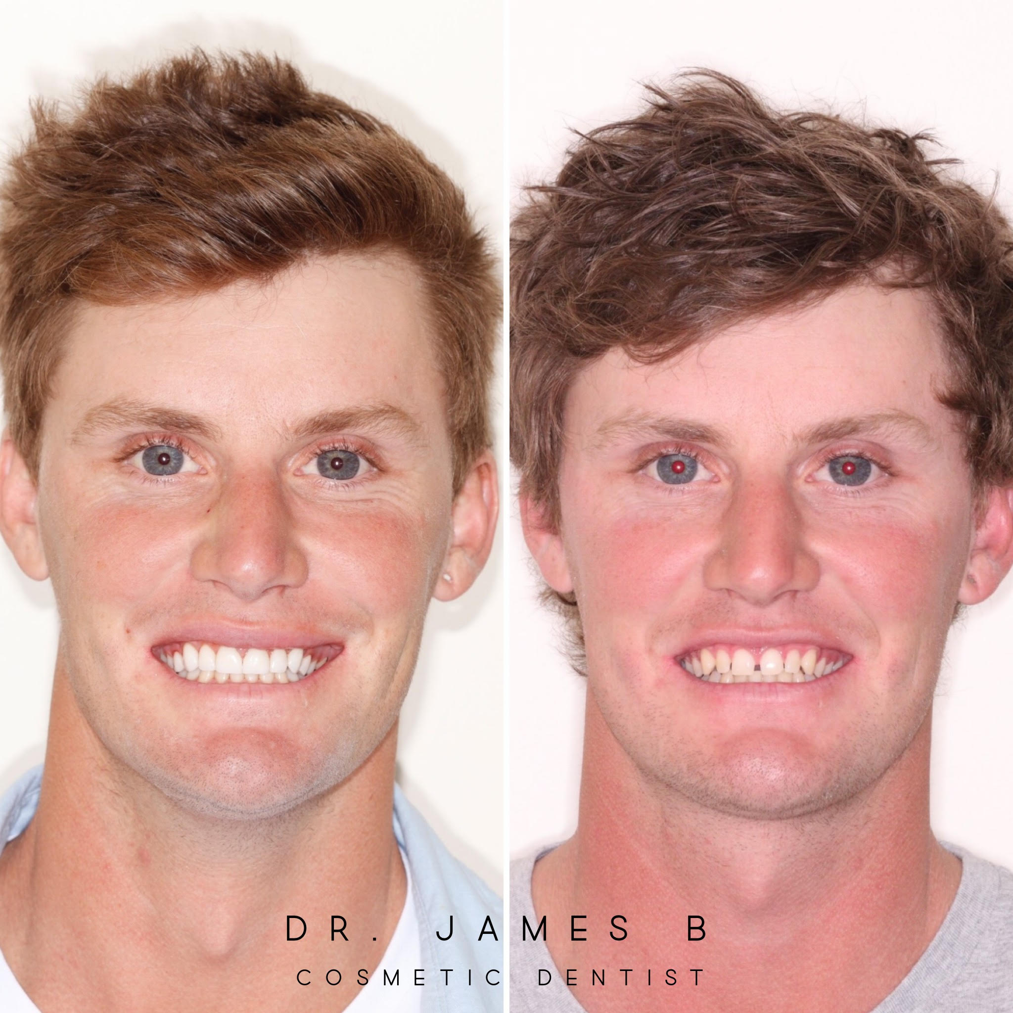 Teeth Whitening Before & After