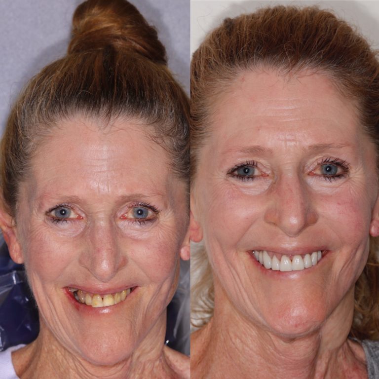 Old Woman Smile Makeover