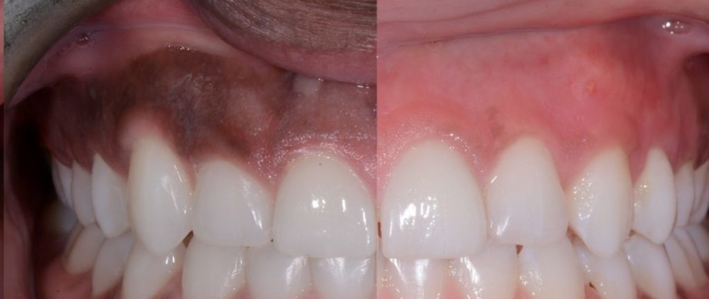 Laser Gum Depigmentation