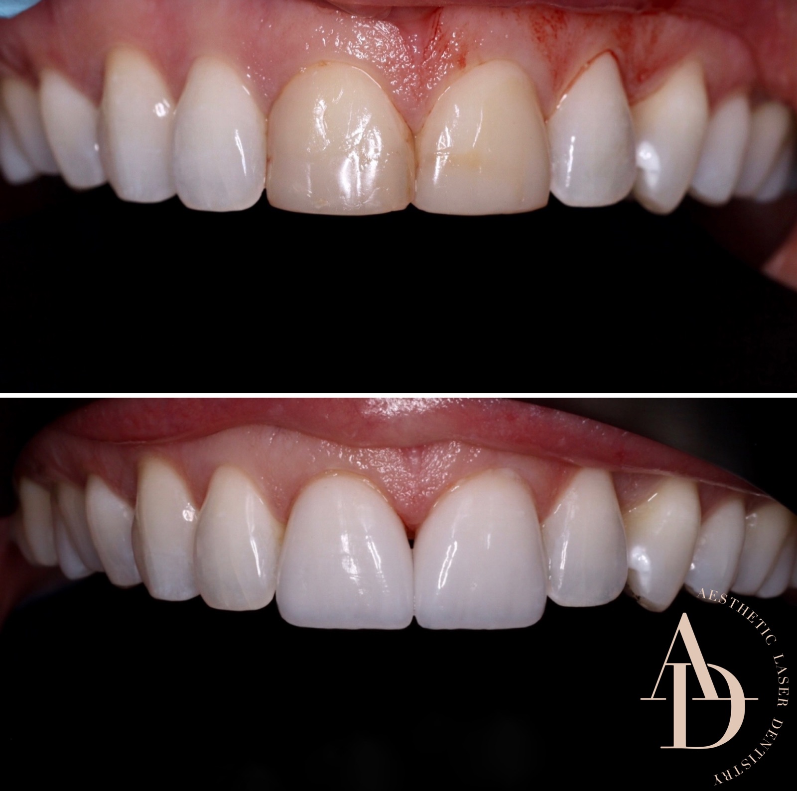 Dental Crowns Before & After