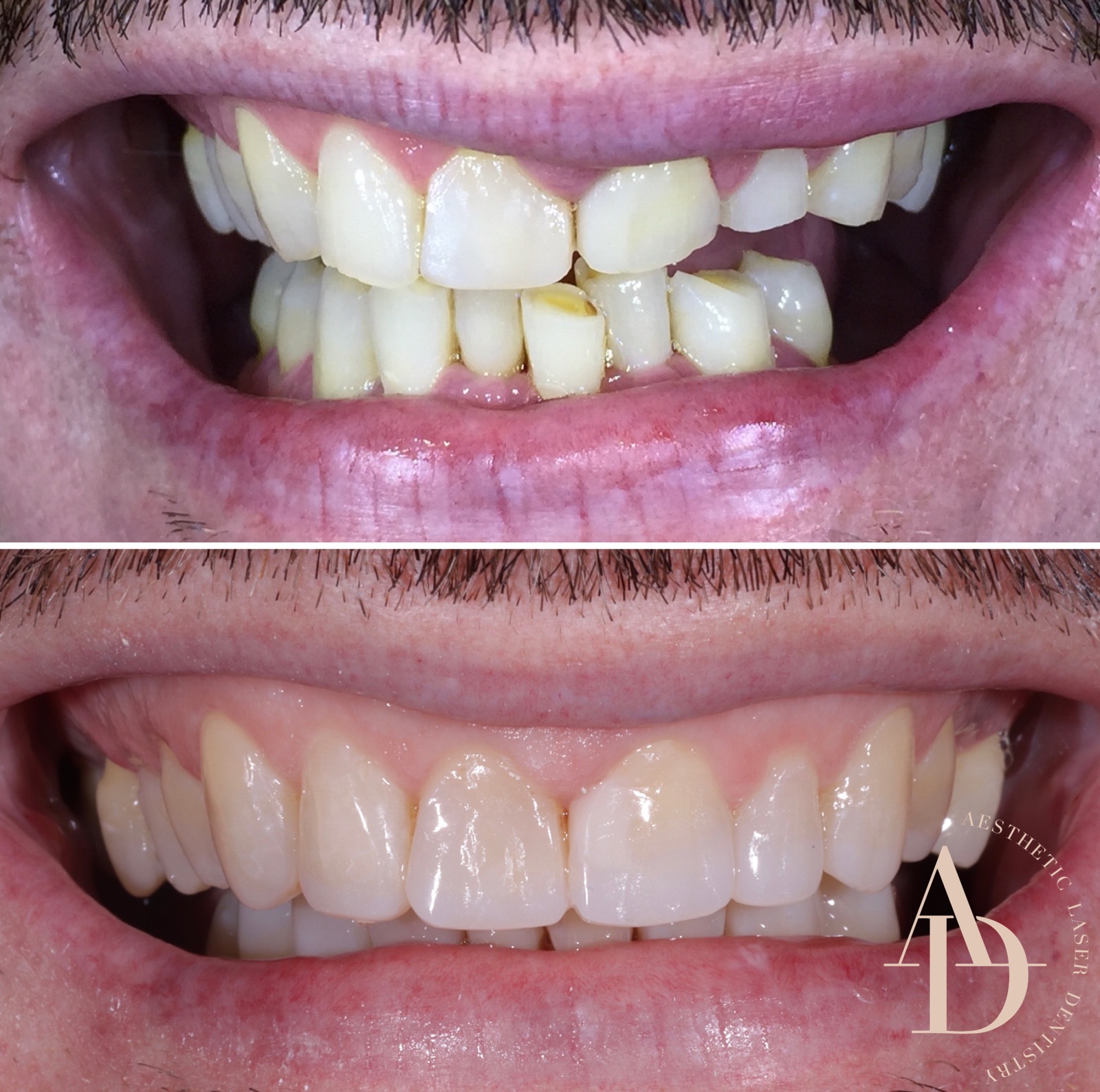 Clear Aligners Before & After