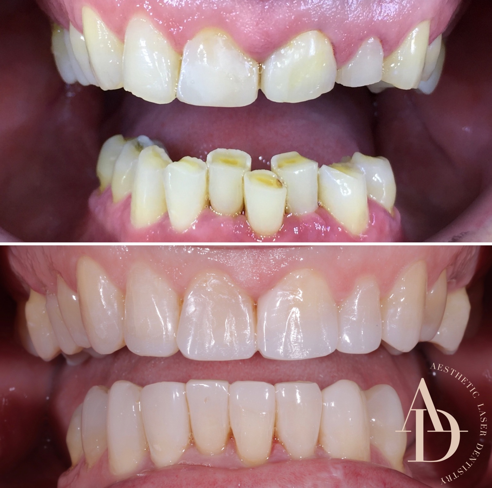Clear Aligners Before & After