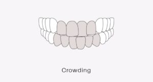 Malocclusion clear aligners_(1)