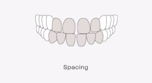 Malocclusion clear aligners_(2)